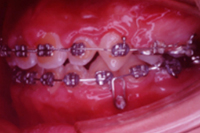 矯正歯科治療の対応症例