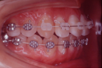 矯正歯科治療の対応症例