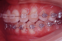 矯正歯科治療の対応症例