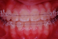 矯正歯科治療の対応症例