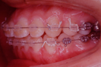 矯正歯科治療の対応症例